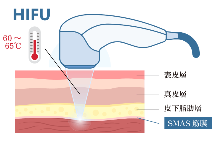 ハイフ使用中の肌断面イメージ画像