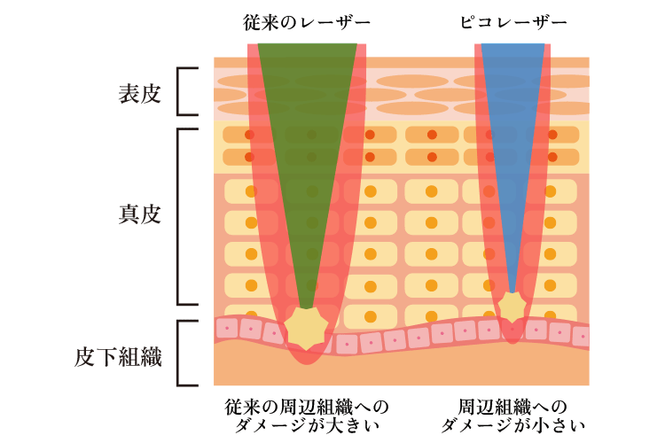 従来のレーザーとの比較イメージ画像
